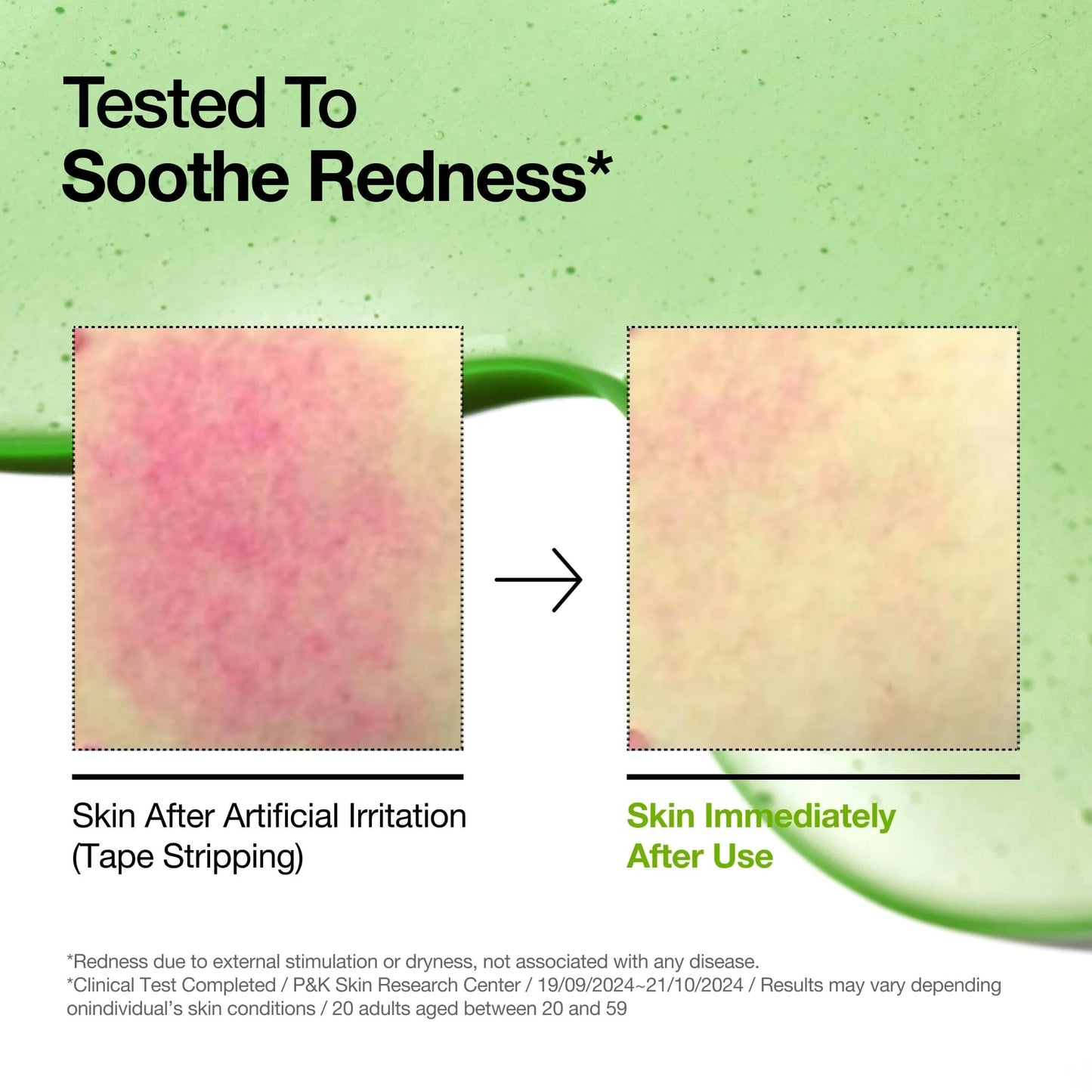 AZELAIC ACID 10 30ML HYALURON REDNESS SOOTHING SERUM