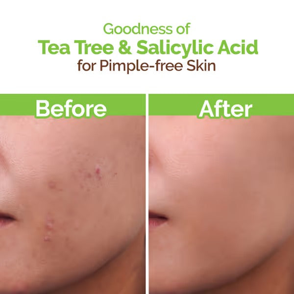 TEA TREE FACEWASH FOR ACNE & PIMPLES 100ML